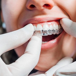 Dentist with white gloves putting on clear aligner