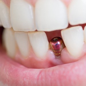 A closeup of a single tooth implant’s abutment