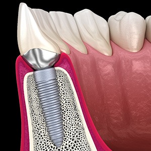 A 3D illustration of a dental implant and its crown