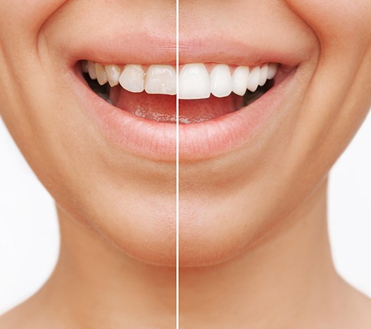 Patient's smile before and after veneers