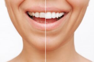 Woman before-and-after smile with cosmetic dentistry