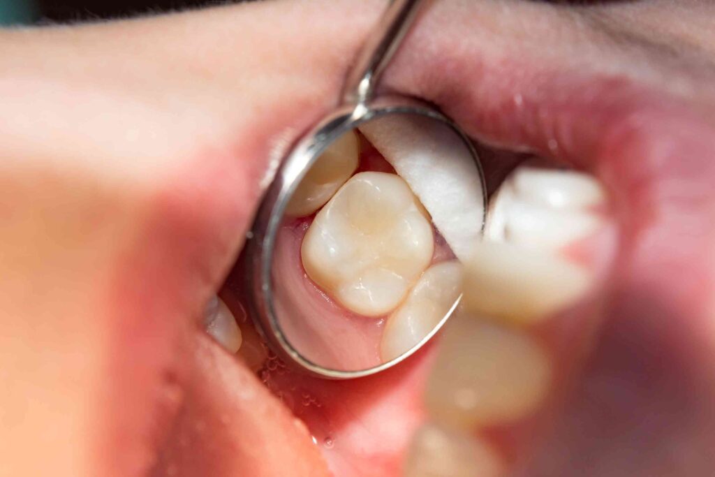 Closeup of a tooth-colored filling